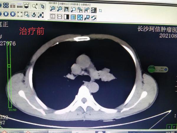 「病例分享」53歲肺鱗癌患者，出現咯血，兩週期治療後腫瘤消失
