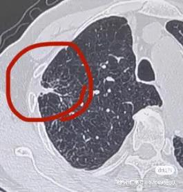 氬氦刀冷凍活檢隨訪篇