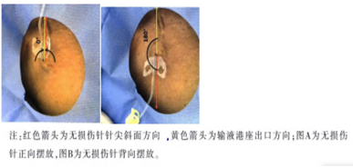 敲黑板！輸液港無損傷針這些知識點，你知道嗎？