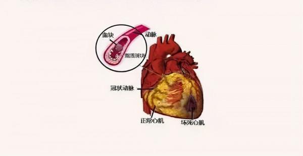 我和心腦血管疾病抗爭的故事 我和心腦血管疾病抗爭的故事