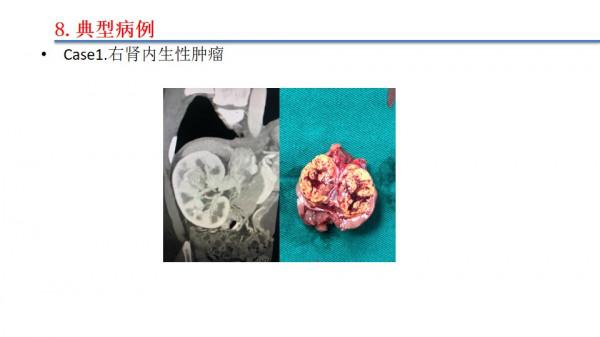 南昌大學二附院泌尿外科江偉凡博士分享腹腔鏡腎部分切除術治療複雜腎腫瘤的新進展及疑難病例