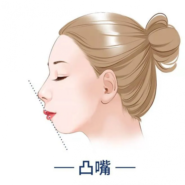 矯正前需明確真性突嘴與假性凸嘴