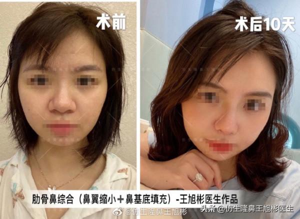 鼻頭縮小可以只“減脂”，不取自體軟骨做支架嗎？