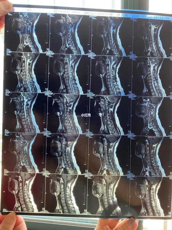 交感神經型頸椎病:最複雜多變、最痛苦難受的頸椎病 交感神經型頸椎病:最複雜多變、最痛苦難受的頸椎病