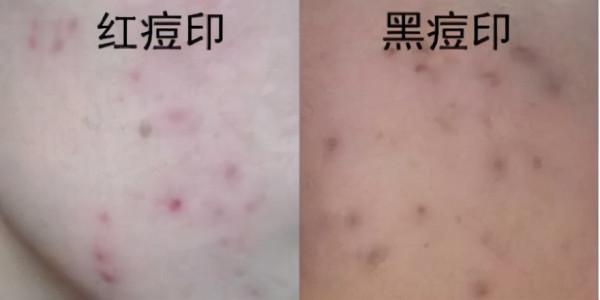 面板黃，怎麼辦？如何變成冷白皮？一次性告訴你去黃的所有方法