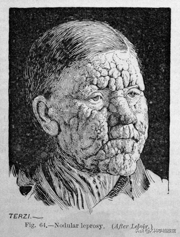 令人聞風喪膽的麻風病，在野生黑猩猩群體首次被發現，意味著什麼