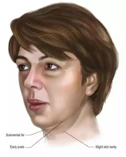 「案例分析」49歲的李女士，PSV面部提升後，脖子怎麼也變長了？