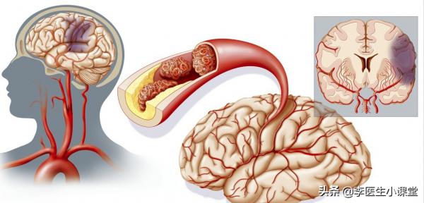 腦梗死越來越多,哈佛大學醫學院:堅持做到這5件事,遠離腦梗 腦梗死越來越多,哈佛大學醫學院:堅持做到這5件事,遠離腦梗
