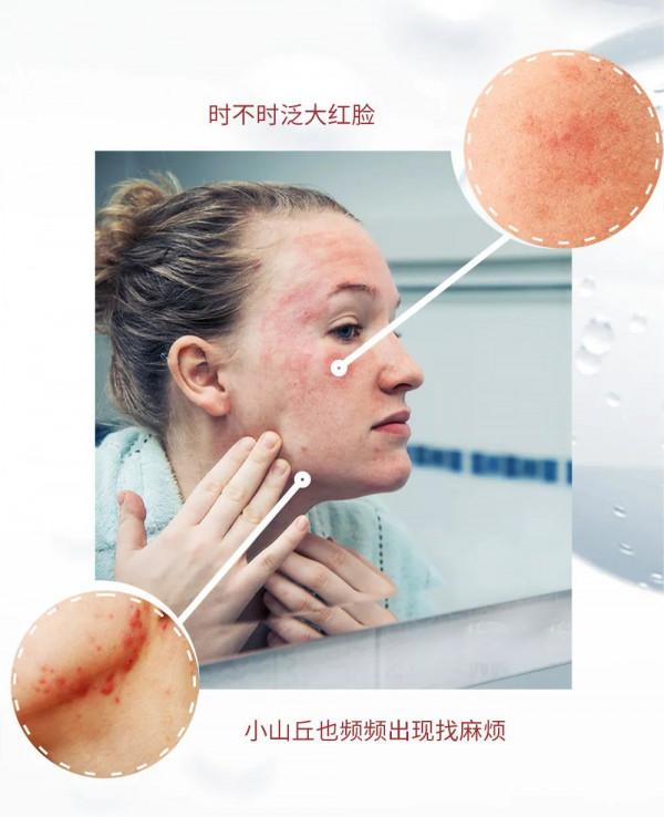 顏究院｜初春躁&OpenCurlyDoubleQuote;肌&rdquo;，一招擺平