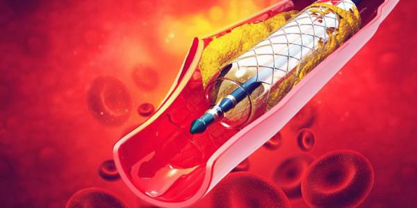 血管介入植入材料的創新與發展 血管介入植入材料的創新與發展