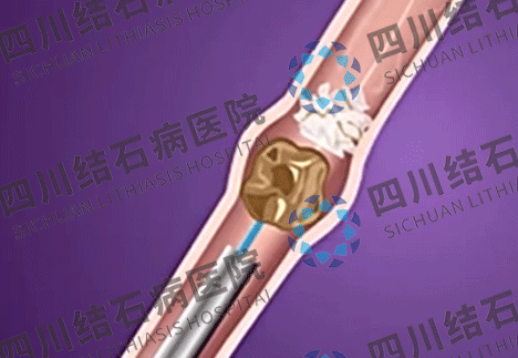 結石發作時生不如死!若不想被“纏上”,建議收藏這份防控指南 結石發作時生不如死!若不想被“纏上”,建議收藏這份防控指南