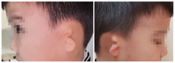 小男孩先天小耳朵聽力缺失,羊城醫生創新方案同步解決倆問題 小男孩先天小耳朵聽力缺失,羊城醫生創新方案同步解決倆問題