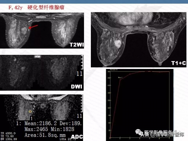 乳腺T2WI高訊號腫瘤病變的診斷思路 乳腺T2WI高訊號腫瘤病變的診斷思路