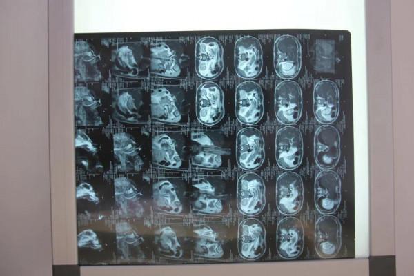 男子腹痛難耐危及生命，竟是膽結石惹的禍，你還覺得這是小病嗎？