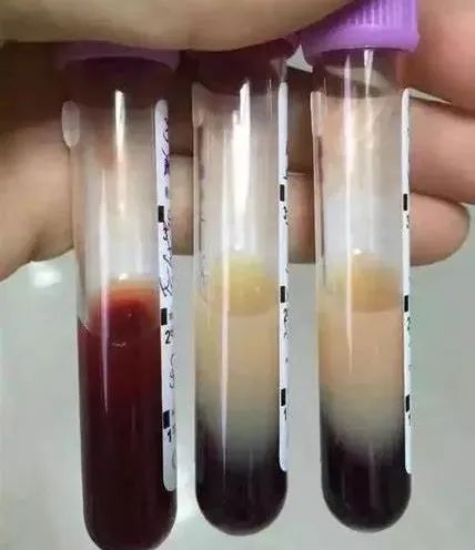 53歲阿姨一頓吃了3斤牛肉+海參燉雞,結果進了ICU 53歲阿姨一頓吃了3斤牛肉+海參燉雞,結果進了ICU