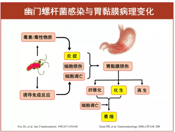 胃病吃點藥以為就痊癒了,醫生從他胃部摘出個“菠蘿包”,與這種菌密切相關 胃病吃點藥以為就痊癒了,醫生從他胃部摘出個“菠蘿包”,與這種菌密切相關