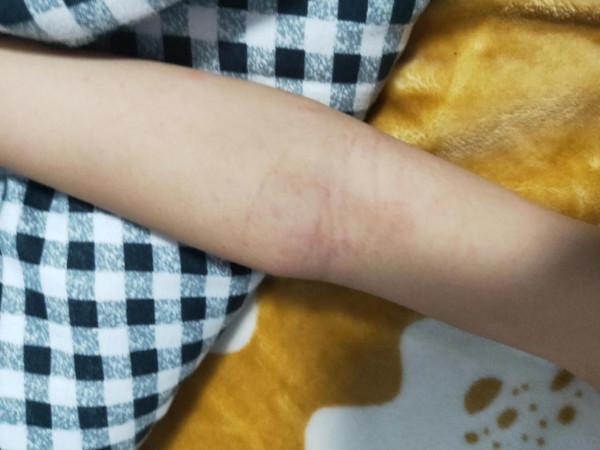 6歲寶寶接種新冠疫苗後