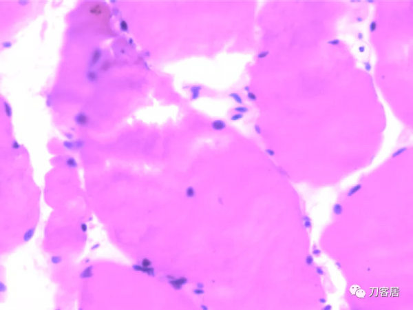 惡性高熱第3例：12歲，脊柱側彎，矯形術後死亡