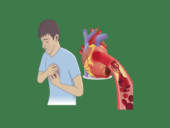 &OpenCurlyDoubleQuote;血脂疫苗&rdquo;PCSK9抑制劑，一年注射2次，適宜哪些人群？