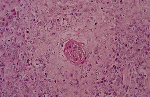 體內有癌,面板先知!醫生:面板出現4種異常的痣,別拖延檢查 體內有癌,面板先知!醫生:面板出現4種異常的痣,別拖延檢查