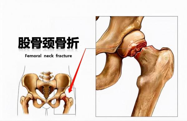 老人股骨頸骨折，關節置換，還是螺釘固定？看看醫生怎說