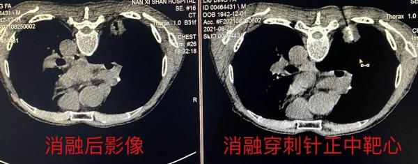 患者福音!治療惡性腫瘤新手段來了 患者福音!治療惡性腫瘤新手段來了