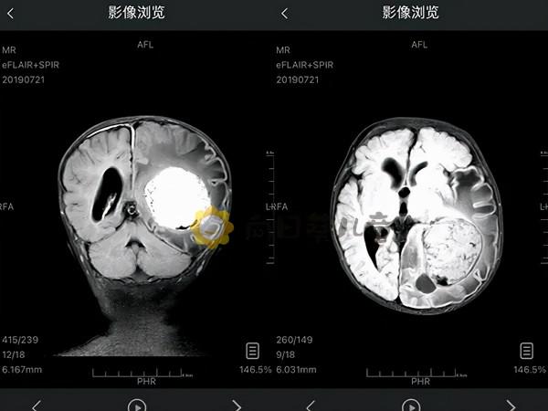 4個月腦瘤嬰兒半年開顱5次 90後新手父母帶兒披荊斬棘