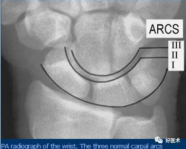 贊！腕關節X線高畫質解剖+腕骨脫位典型病例