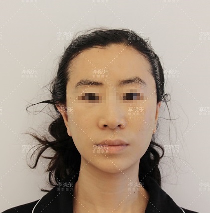 「53歲的趙女士」PSV面部提升術後30天，親身經歷解答大家的疑問