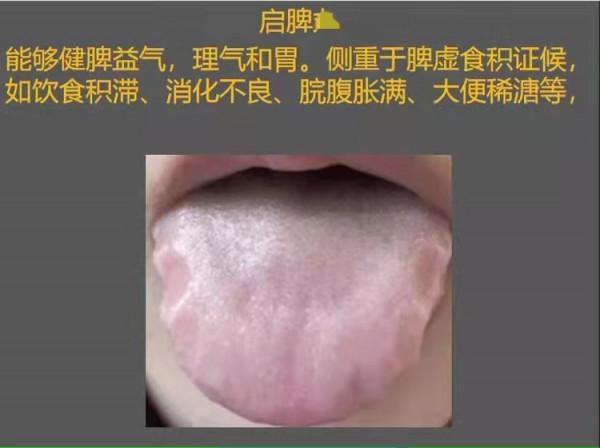 舌有齒痕？脾虛？怎麼辦