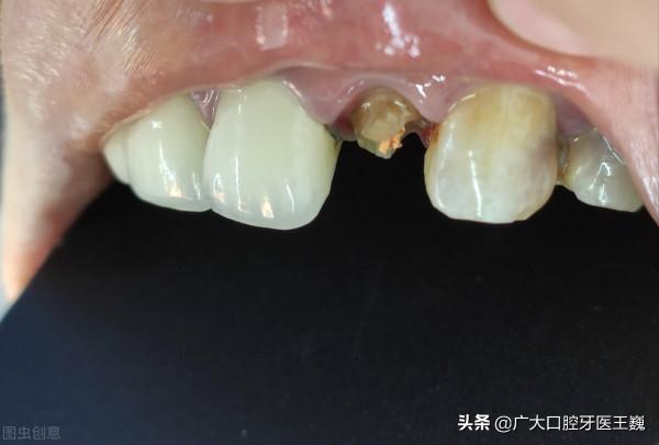 老年人裝假牙，學會5點才能越戴越健康