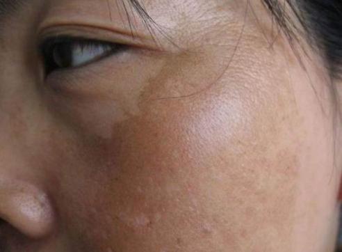 43歲杭州女士，長期靠維生素E來淡斑，現在怎麼樣了？