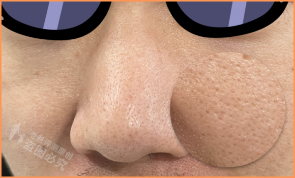 毛孔粗大怎麼辦?超全指南解決你的毛孔問題 毛孔粗大怎麼辦?超全指南解決你的毛孔問題