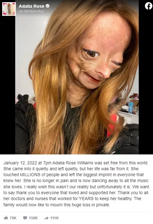 患早衰症15歲千萬粉絲少女博主逝世，粉絲：她終於不再痛苦了