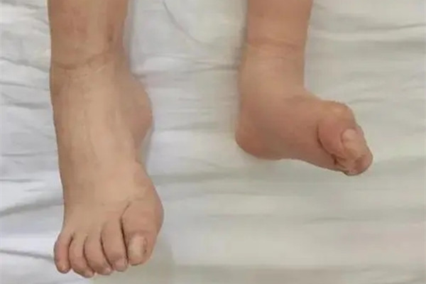 孩子高熱不退且關節紅腫，是類風溼的前兆？