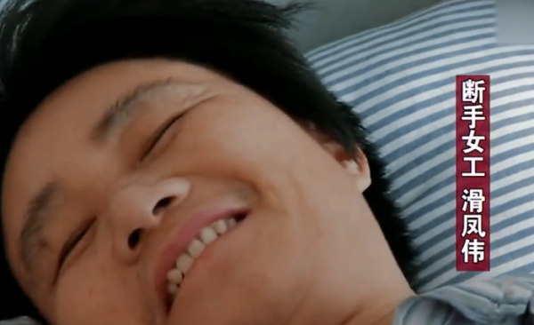 河南43歲女工捲入絞肉機，右手斷成9節，醫生苦撐17小時為其接上