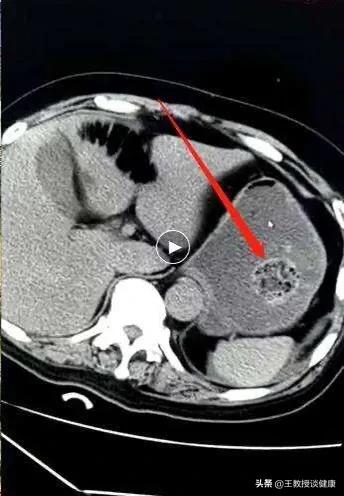 大量食用柿子、山楂、大棗—胃腸道不堪承受的美味 大量食用柿子、山楂、大棗—胃腸道不堪承受的美味