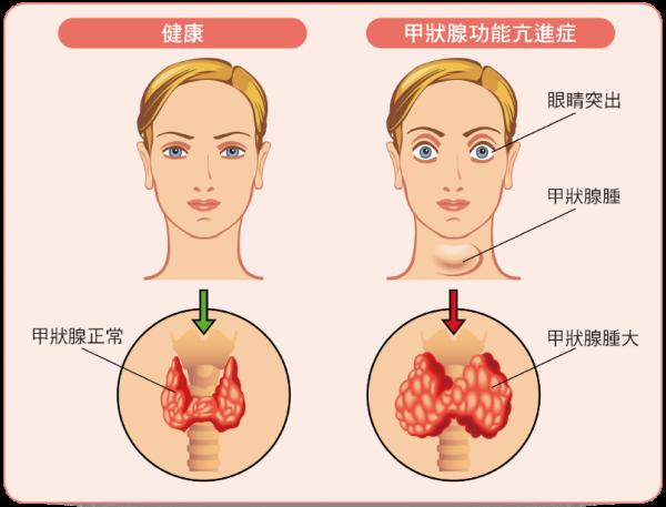 為什麼有的人愛出汗？醫生：原因無外乎這3點，多留點心