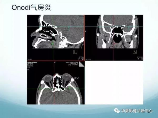 頭頸五官CT斷層解剖圖及常見病影像診斷