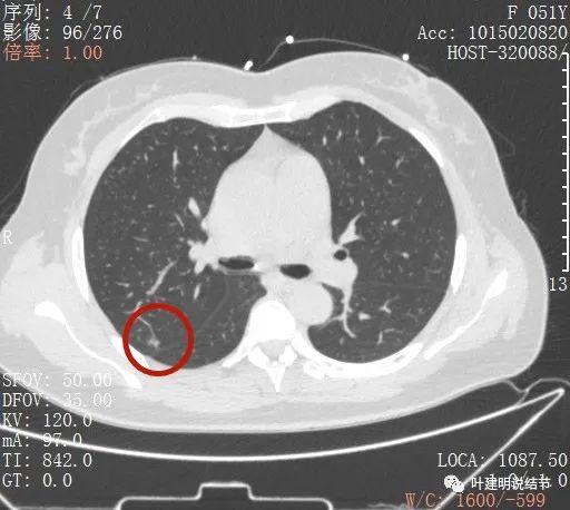 指南說小於5毫米的肺結節不需要隨訪，打臉來了