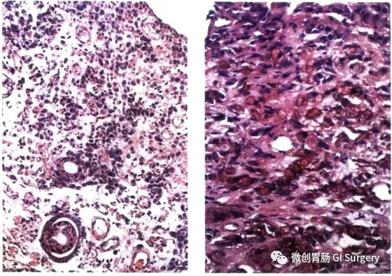 什麼是Borrmann IV型（瀰漫型）胃癌？