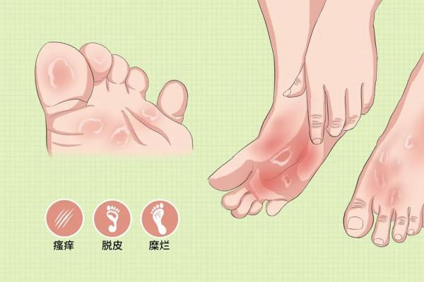 別拿“腳氣”不當回事兒!有腳氣要做好這10件事 別拿“腳氣”不當回事兒!有腳氣要做好這10件事