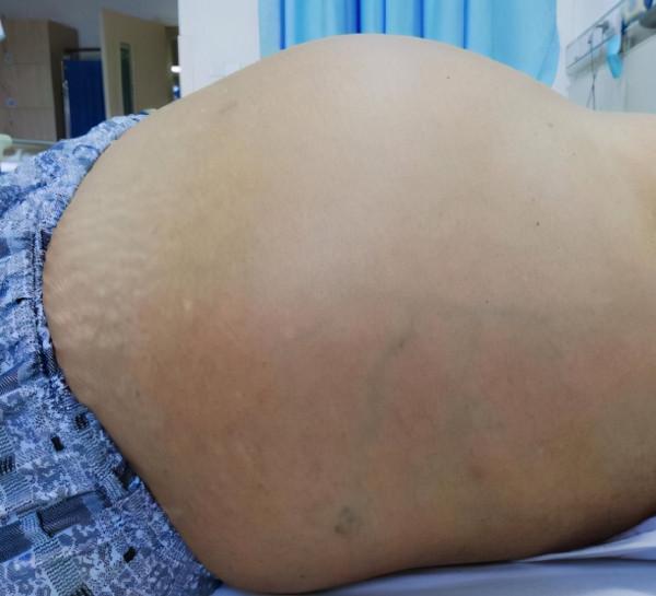 如果出現這些症狀，可能你的肝臟出了問題