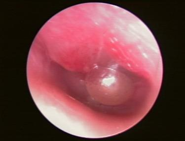 耳朵疼痛較重，小心大皰性鼓膜炎