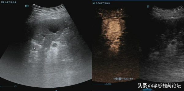 高空墜落僅輕傷?超聲影像科發現貓膩 高空墜落僅輕傷?超聲影像科發現貓膩
