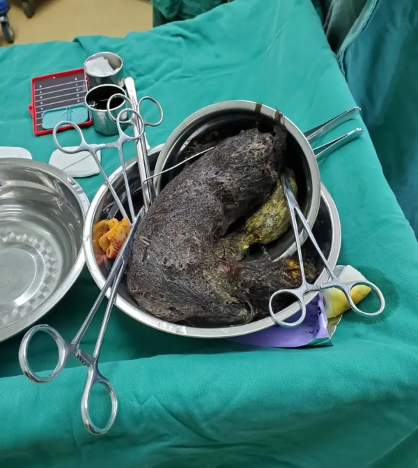 廣西一13歲小女孩反覆腹痛半月餘，醫生從其胃裡取出一大團頭髮