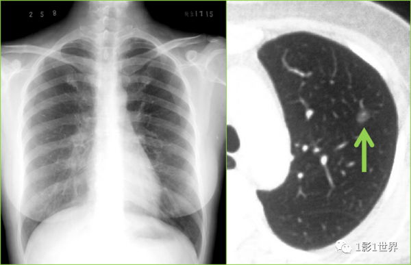 影像檢查“未見異常”就說明沒事嗎？