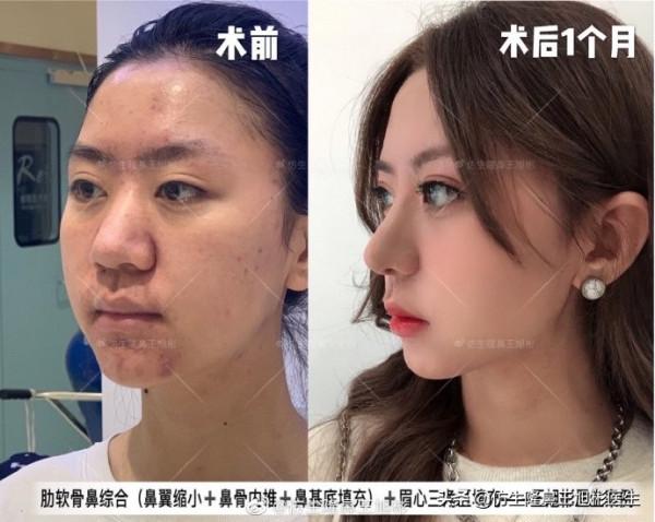 鼻頭縮小可以只“減脂”，不取自體軟骨做支架嗎？