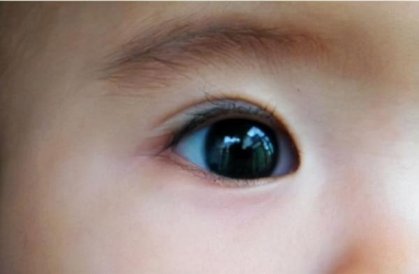 孩子眼白有“黑點”，需要治療嗎？