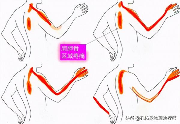 後背、肩胛骨內側緣疼痛,是怎麼回事?該如何處理?給您講清楚 後背、肩胛骨內側緣疼痛,是怎麼回事?該如何處理?給您講清楚